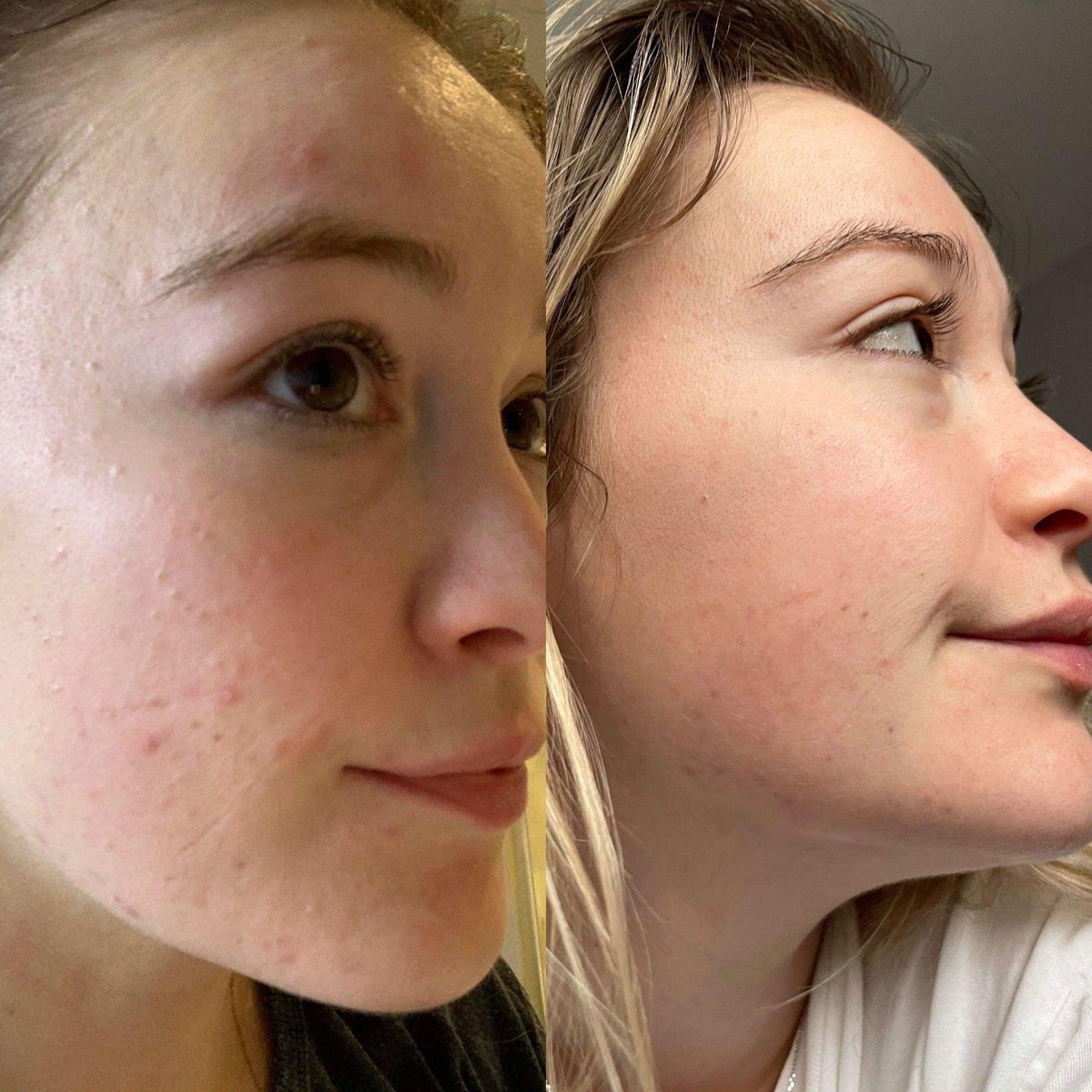 Douvall's Argan Acne Rehab Serum 30ml | Plant-Based Formula for Acne-Prone Skin