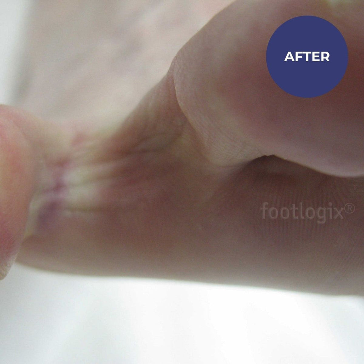 Footlogix Peeling Skin Formula 125ml