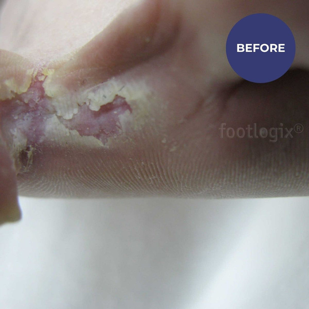 Footlogix Peeling Skin Formula 125ml