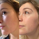 Douvall's Argan Acne Rehab Serum 30ml | Plant-Based Formula for Acne-Prone Skin