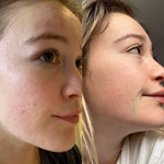 Douvall's Argan Acne Rehab Serum 30ml | Plant-Based Formula for Acne-Prone Skin