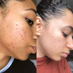 Douvall's Argan Acne Rehab Serum 30ml | Plant-Based Formula for Acne-Prone Skin