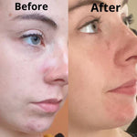 Douvall's Argan Acne Rehab Serum 30ml | Plant-Based Formula for Acne-Prone Skin