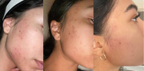 Douvall's Argan Acne Rehab Serum 30ml | Plant-Based Formula for Acne-Prone Skin