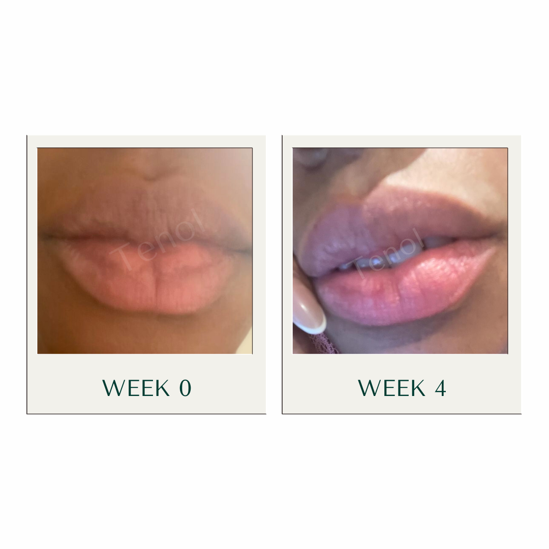 Tenol Lip Remedy Kit (Regular Strength Kit) - Reverse Lip Hyperpigmentation and Repair Lips