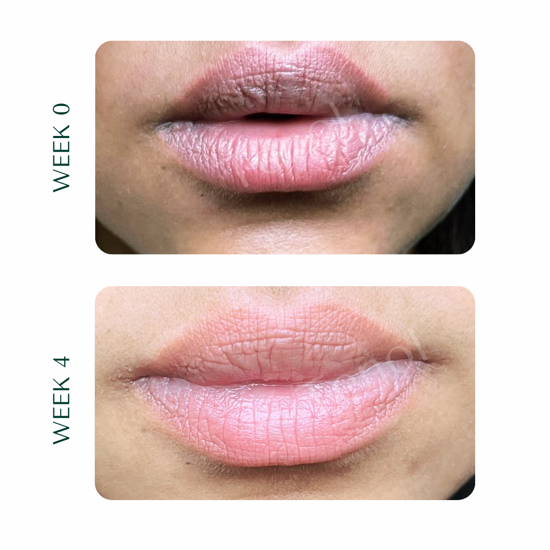 Tenol Lip Remedy Kit (Regular Strength Kit) - Reverse Lip Hyperpigmentation and Repair Lips
