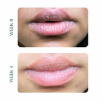 Tenol Lip Remedy Kit (Regular Strength Kit) - Reverse Lip Hyperpigmentation and Repair Lips