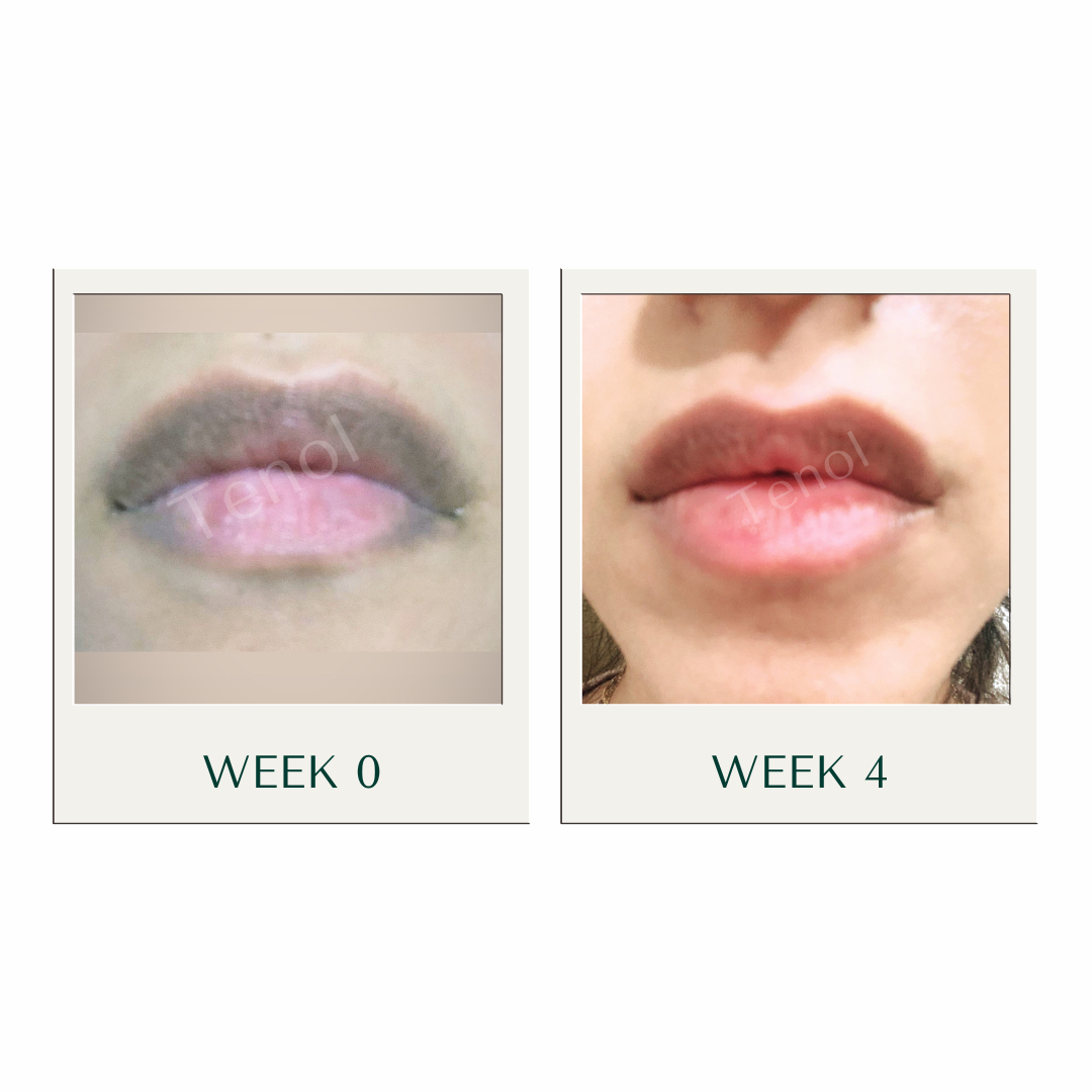 Tenol Lip Remedy Kit (Regular Strength Kit) - Reverse Lip Hyperpigmentation and Repair Lips